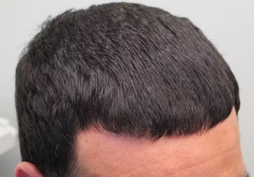 I heal the hair of the Verdoxidil room