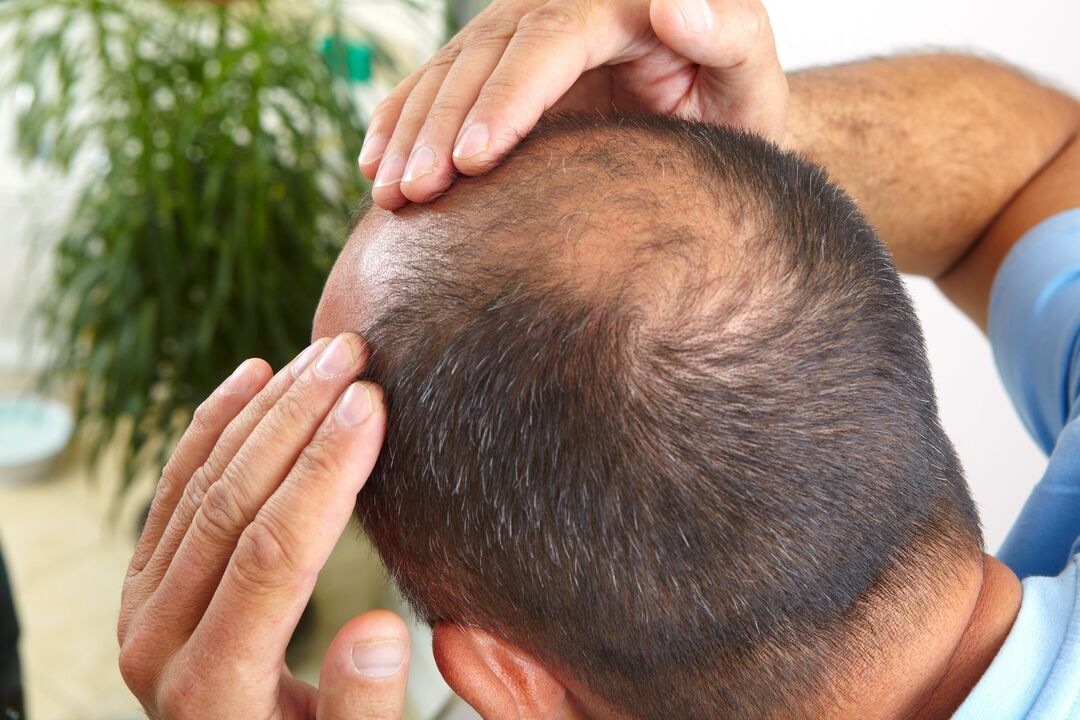 rubbing spray spray for bald treatment
